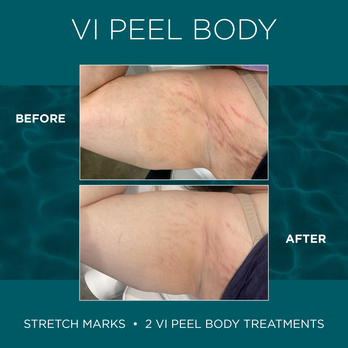 Chemical Peels